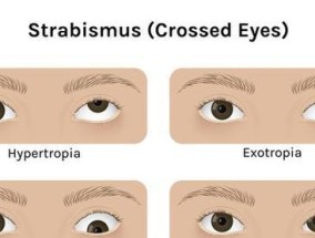 斜视的成因是什么？如何预防和治疗？