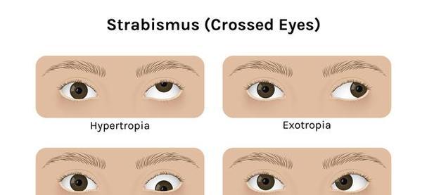 斜视的成因是什么？如何预防和治疗？  第1张